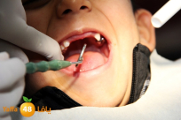 بدء علاج الأسنان المجاني للقاصرين حتى جيل 18 وللمسنين ما فوق 75